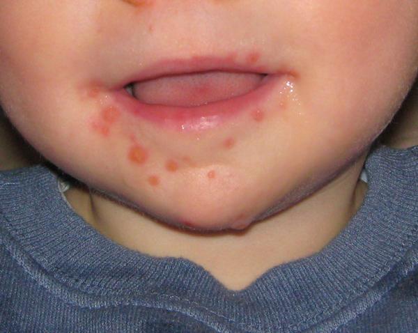 in the season of high incidence of hand- foot-and-mouth disease, there are children at home, how to let children not be "recruited"?